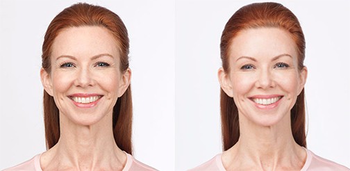 Before and After Botox Treatment for moderate to severe frown lines
