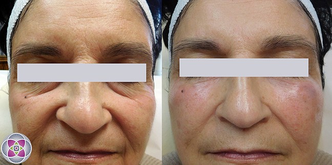Before and after dermal fillers under the eyes