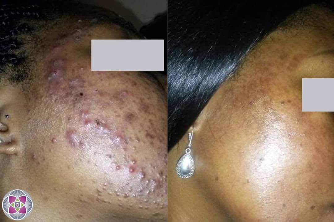 Lasers are the best and safest option for treating severe cystic acne on darker skin and the results are truly fantastic.