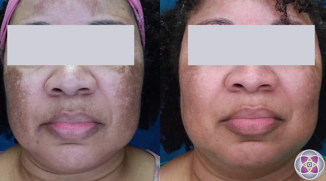 Even the most challenging cases of melasma, occurring in darker skinned women, can be effectively treated with AMA Regenerative Medicine & Skincare’s advanced laser protocols.