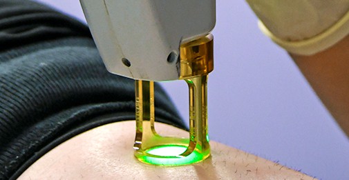 Laser hair removal with a Candela hair removal device.