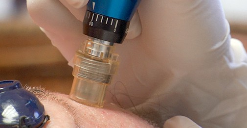 Close-up of microneedling device being used on a person's face