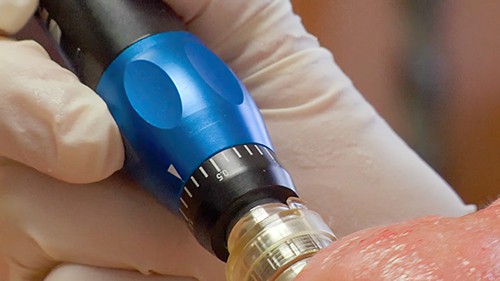 Close-up of microneedling pen on patient's chin.