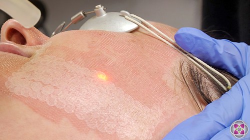 Patient having erbium laser performed on face.