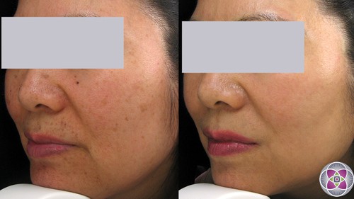 before and after pigmentation treatment.