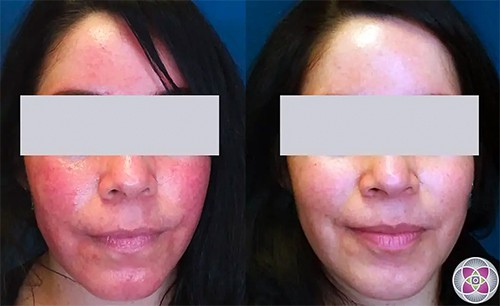 Before and after laser rosacea treatment.