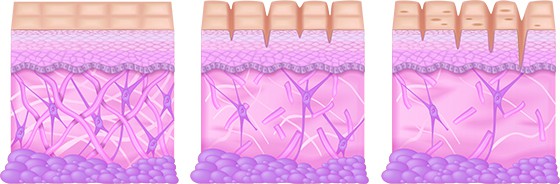 Three images of skin showing how collagen breaks down.