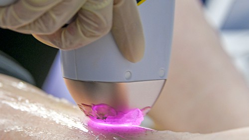 Diode laser hair removal of the legs.