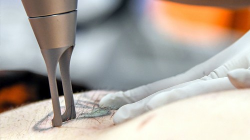 A q-Switched laser being used to remove a tattoo from a patient.