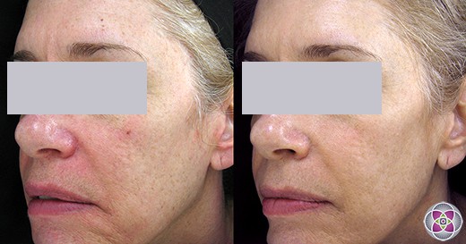 The redness of rosacea can be removed with lasers treatment. There are a variety of lasers that are attracted to vascularization so we can customize the treatment to your skin.
