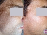 Acne scar reduction 2