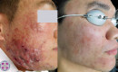 Before and After Laser Acne Treatment