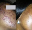 Before and After Laser Acne Treatment