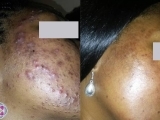 Laser treatment eliminates the acne cysts and reduces the scarring at the same time.