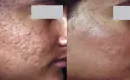 Before and After Laser Treatment for Acne Scars
