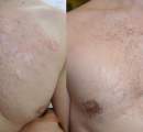 Before and After Lasers, Subcision and Stem Cells for Acne Scars on the Chest