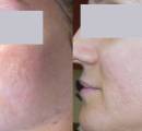 Laser acne scar removal