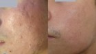 Laser Treatment for Acne Scars