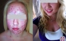 Before and after laser treatment for acne