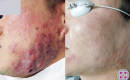 Before and after laser treatment for severe cystic acne on the left cheek of a male patient