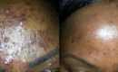 Before and after laser acne treatment on the forehead of a patient with dark skin