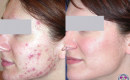 laser acne treatment before and after photo