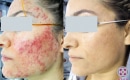 Before and after laser treatment for severe cystic acne on the left side of a female patient's face