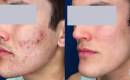 Laser Treatment to Remove Cystic Acne