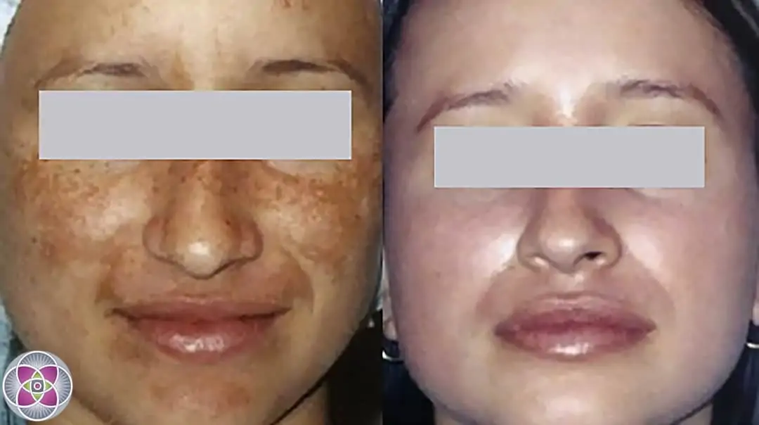 Laser treatment for age spots on face