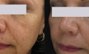 Facial age spot removal
