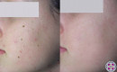 Before and After Laser Age Spot Removal on the Face