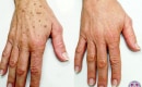 Before and After Laser Age Spot Removal on the Hands