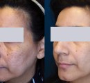 Removal of age spots on the face