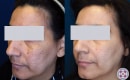 Agespot-removal-before-and-after-5
