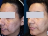 Removal of age spots on the face