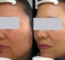 Removal of sun spots on the face