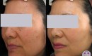 Removal of sun spots on the face