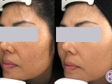 Sun spots on face removal