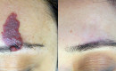 Before and after laser birthmark removal of hemangioma on the forehead.