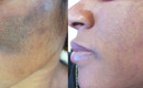 Before and after laser birthmark removal of Cafe-au-lait spot on dark skin