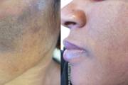 Before and after laser birthmark removal of Cafe-au-lait spot on dark skin