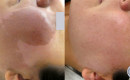 Before and after laser birthmark removal of Cafe-au-lait spot on the face