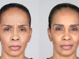 Botox Cosmetic injections for women.