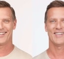 Before and After Botox Treatment