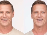 Before and after treatment for Botox.