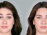 Young female before and after botox cosmetic.