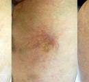 Before and after laser spider vein removal on the legs