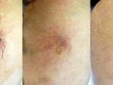 Before and after laser spider vein removal on the legs