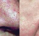 Before and after laser spider vein removal on the nose