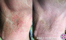 laser-spider-vein-removal-neck-male-before-and-after